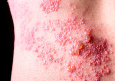 Herpes zoster (com imagem)