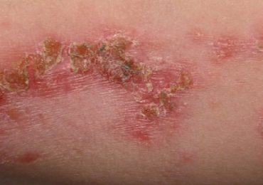 Impetigo: causas, diagnóstico e tratamento