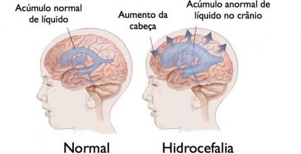 Hidrocefalia Causas Diagnóstico E Tratamento Mãe Me Quer 5916