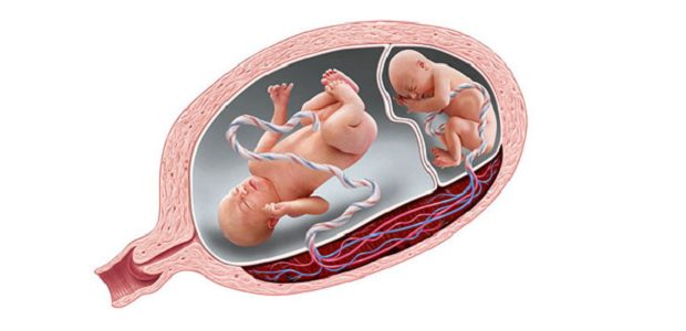 Síndrome de transfusão feto-fetal