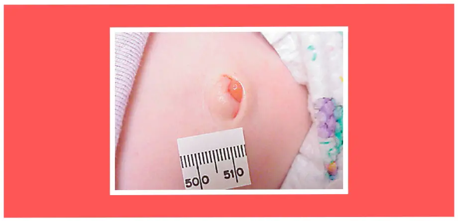 PT – Understanding Umbilical Granuloma